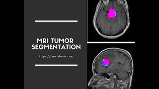 Brain MRI Tumor Segmentation in MATLAB [upl. by Annaej]