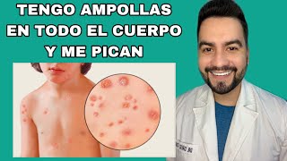 TENGO AMPOLLAS EN EL CUERPO LLENAS DE LIQUIDO  VARICELA  DR DAVID CAMPOS [upl. by Daph]