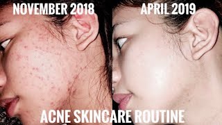 How I Cleared my Acne amp Pimples in 1 Month using Kojie San Soap amp Eskinol  DalacinC 🙈🤍🧖🏻‍♀️ [upl. by Ainahtan]