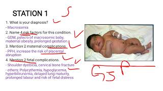 Macrosomia Case Study [upl. by Muller]