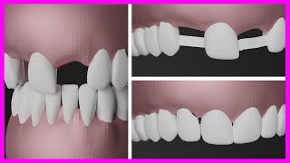 PERDI um DENTE e NÂO QUERO FAZER IMPLANTE veja uma alternativa ao implante dentário [upl. by Ellecrag]