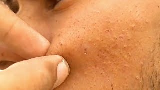 sac be spa blackheads elderly 2024  sac be spa old age blackheads acne  sac be spa face today 480 [upl. by Livingston84]