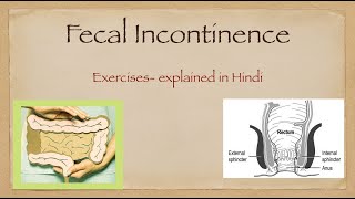 Fecal Incontinence explained in hindi [upl. by Atnek156]