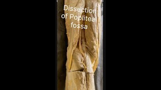 Popliteal fossa Dissection of popliteal fossa Anatomy of popliteal fossa Contents popliteal fossa [upl. by Aisatal]