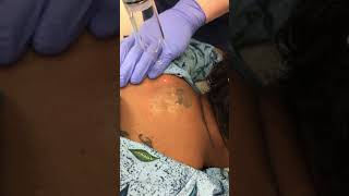 PiQo4 Advanced Laser Tattoo Removal [upl. by Ccasi]