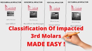 Classification of Impacted 3rd Molars  Oral Surgery [upl. by Asilanna]