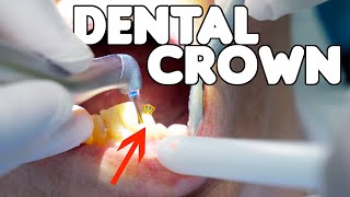 Dental Crown Procedure EXPLAINED [upl. by Enimrej]