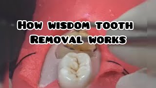 How wisdom tooth removal works 🦷 teeth wisdom removal operater dentist viralvideo reaction [upl. by Eednas]