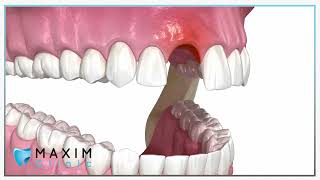 Bottransplantatie  Maxim Clinic [upl. by Sunderland]