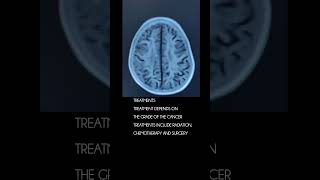 Glioblastoma cancer [upl. by Galloway]