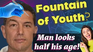 Man looks HALF HIS AGE after surgery Astonishing results medical fountainofyouth plasticsurgery [upl. by Nelleus]