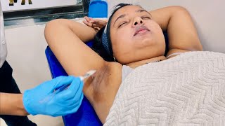 Dark Underarms Treatment  Dark Underarms and Mouth Around Pigmentation Treatment [upl. by Joelie]