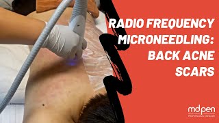 RF Microneedling Back Acne Scars Treatment [upl. by Naeerb]