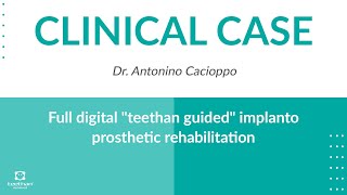 CLINICAL CASE  Full digital quotteethan guidedquot implanto prosthetic rehabilitation [upl. by Ultan204]