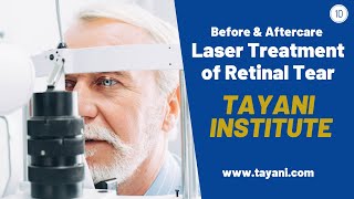 Laser Treatment of Retinal Tear  Tayani Institute [upl. by Aniluj40]