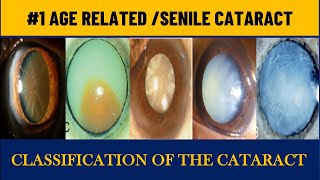 Age related Cataract  Senile cataract stages [upl. by Fabian]