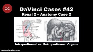 Intraperitoneal vs Retroperitoneal Hemorrhage DaVinciCases Renal 2  Anatomy Case 2 [upl. by Eng]