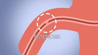 Animación uretroplastia con balón con Paclitaxel [upl. by Asiruam419]