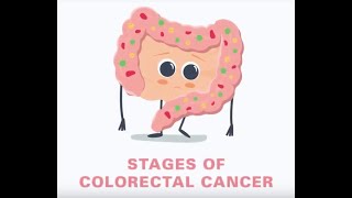 5 Stages of Colorectal Cancer Explained  Parkway Cancer Centre [upl. by Zetrac860]