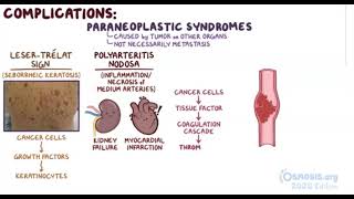 Gastric Cancer  Osmosis [upl. by Yeleek]