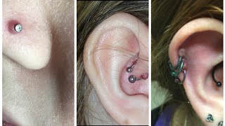 How do I get rid of a Keloid  hypertrophic scar aka piercing bump [upl. by Leigha]