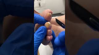 Dare to bare your soles Watch how our Aussie podiatrist tackles toe callus [upl. by Adnawot]