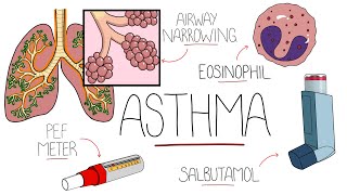 Asthma Explained Including Pathophysiology [upl. by Naaman]