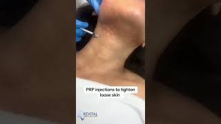 PRP Plateletrich plasma treatment prp prptreatment sugarland houstontx medspa skincare [upl. by Acilegna316]