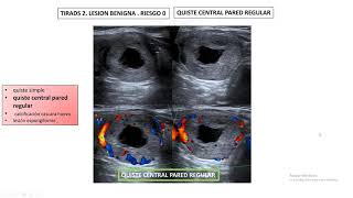 TI RADS CLASIFICACION TI RADS [upl. by Gaulin765]