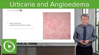 Urticaria Hives and Angioedema – Pediatrics  Lecturio [upl. by Claudio]