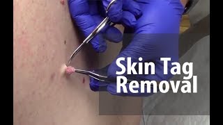 Skin Tag Mole and Wart Removal Kit Amazon Review [upl. by Ehr]