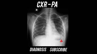 Diagnosis  Chest X Ray  Practical case  Radiology [upl. by Polky]