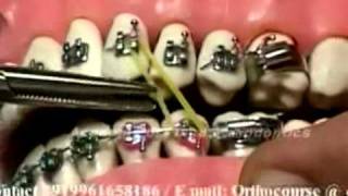 Cl II Cl III Elastics in Orthodontics [upl. by Ludvig698]