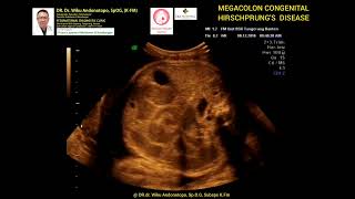 Megacolon congenital  Hirschprung disease [upl. by Etnovert]