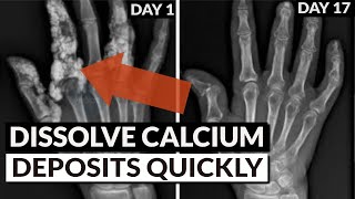 Reverse Soft Tissue Calcification Bring Calcium Out Of Tissue amp Into Bones [upl. by Isobel]