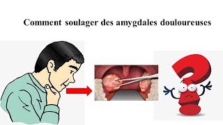 Comment soulager des amygdales douloureuses  Santé générale [upl. by Millisent742]