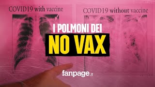 Cosi Covid distrugge i polmoni di chi è senza vaccino parla il medico dellospedale Cotugno [upl. by Collin881]