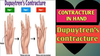 Dupuytrens Contracture in Hindi [upl. by Atig826]