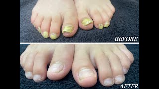 Laser Fungal Nail treatment in 8 year old boy Part 2 [upl. by Notnilc]