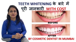 Teeth Whitening के बारे में पूरी जानकारी With Cost  By Cosmetic Dentist In Mumbai [upl. by Annam]