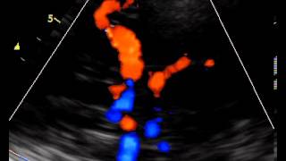 INTRACRANIAL ARTERIES TRANSCRANIAL COLOR DOPPLER [upl. by Acitel]