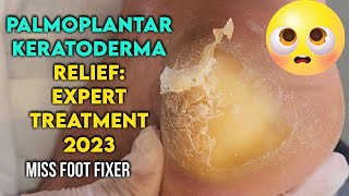 Palmoplantar Keratoderma Relief Expert Treatment for Thick Callus Removal by miss foot fixer [upl. by Appolonia153]