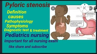 pyloric stenosis  causes  symptoms diagnostic test  treatment  pediatrics nursing Hindi lecture [upl. by Gian]