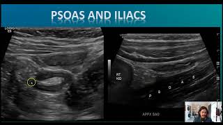 Optimizing The Appendix [upl. by Asoj]