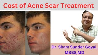 Cost Of Acne Scar Treatment  Cost of Combination Treatment  Acne Scar [upl. by Anastas]