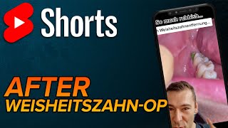 Nach Weisheitszahnentfernung shorts [upl. by Qidas]