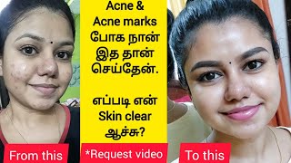 How I cleared my acne  My skincare routine for Acne amp Acne marks  Best products for pimple skin [upl. by Ijan923]