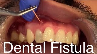 Best Compilation videos of Dental Fistula or Parulis cases  Dental Abscess Dental Infections [upl. by Elephus]