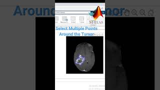 Extract Tumor by Image Segmentation MATLAB DICOM image [upl. by Edac]