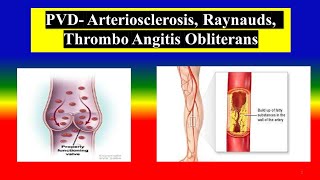 PVD Arteriosclerosis Raynauds Thromboangiitis Obliterans  Define  causes  diagnostic [upl. by Anihs]